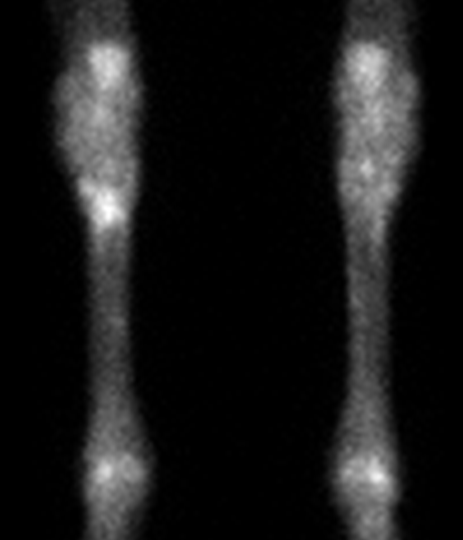 Nuclear medicine bone scan of both lower legs showing tibia and fibula. Areas of increased radiotracer uptake are bright at the knees and ankles, suggesting possible abnormal bone activity.